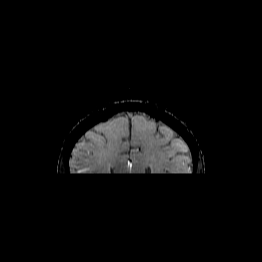 Anterior cingulotomy (ACING) (Radiopaedia 42950-46196 Coronal SWI 3).jpg
