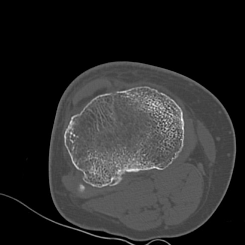 File:Anterior cruciate ligament avulsion fracture (Radiopaedia 58939-66194 Axial bone window 23).jpg