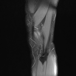 File:Anterior cruciate ligament full thickness tear (Radiopaedia 66268-75467 Sagittal PD fat sat 22).jpg