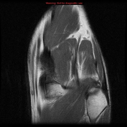 File:Anterior cruciate ligament injury - partial thickness tear (Radiopaedia 12176-12515 D 11).jpg