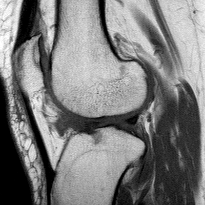 File:Anterior cruciate ligament mucoid degeneration (Radiopaedia 60853-68633 Sagittal T1 18).jpg