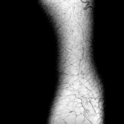Anterior cruciate ligament mucoid degeneration (Radiopaedia 60853-68633 Sagittal T1 29).jpg
