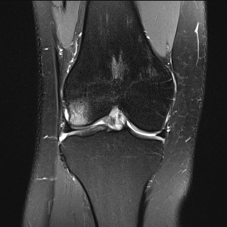 File:Anterior cruciate ligament rupture and posteromedial corner injury (Radiopaedia 67338-76723 Coronal PD fat sat 14).jpg