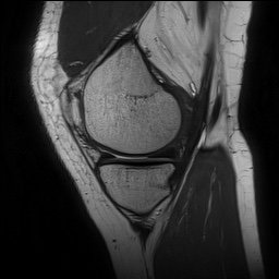 Anterior cruciate ligament rupture and posteromedial corner injury (Radiopaedia 67338-76723 Sagittal PD 49).jpg