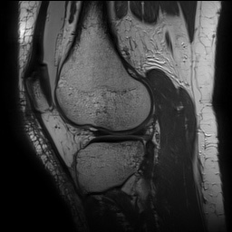 Anterior cruciate ligament rupture with Segond fracture (Radiopaedia 69043-78806 Sagittal PD 134).jpg
