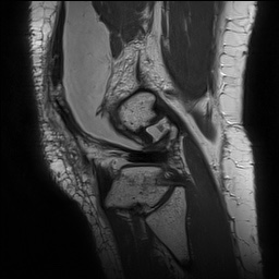 Anterior cruciate ligament rupture with Segond fracture (Radiopaedia 69043-78806 Sagittal PD 154).jpg