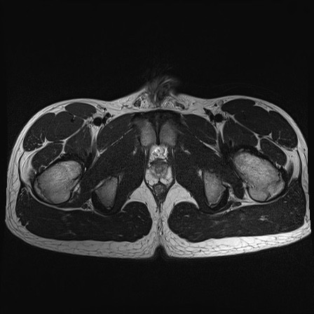 File:Anterior inferior iliac spine avulsion fracture (Radiopaedia 81312-95000 Axial T2 8).jpg