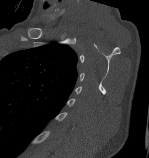 Anterior shoulder dislocation with Hill-Sachs and bony Bankart lesions (Radiopaedia 40424-42974 Sagittal bone window 41).png
