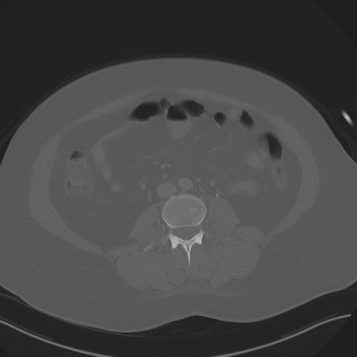 Anterior superior iliac spine avulsion fracture (Radiopaedia 44541-48244 Axial bone window 55).png