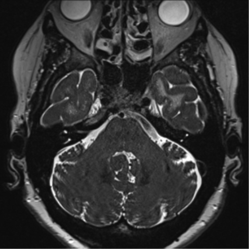 Anterior temporal pole cysts (Radiopaedia 46629-51102 Axial 8).png