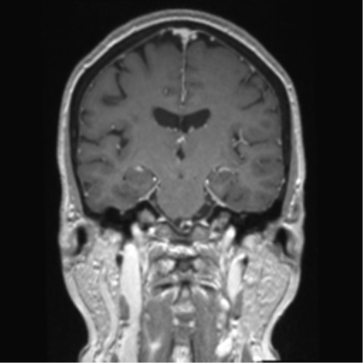 Anterior temporal pole cysts (Radiopaedia 46629-51102 Coronal T1 C+ 83).png