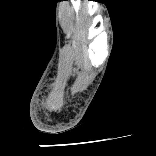 Anterior tibial artery false aneurysm (Radiopaedia 88984-105809 A 225).jpg