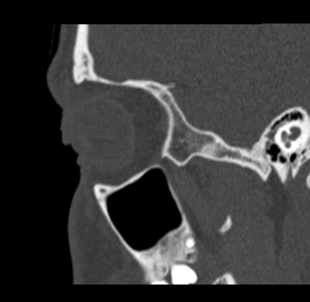 File:Antrochoanal polyp (Radiopaedia 33984-35202 Sagittal bone window 69).jpg