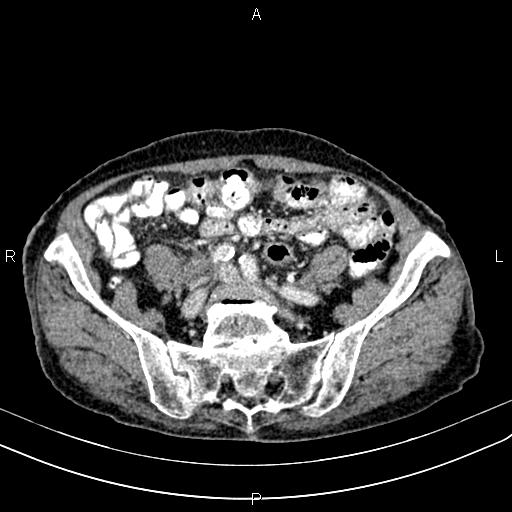 File:Aortic aneurysm and Lemmel syndrome (Radiopaedia 86499-102554 A 59).jpg
