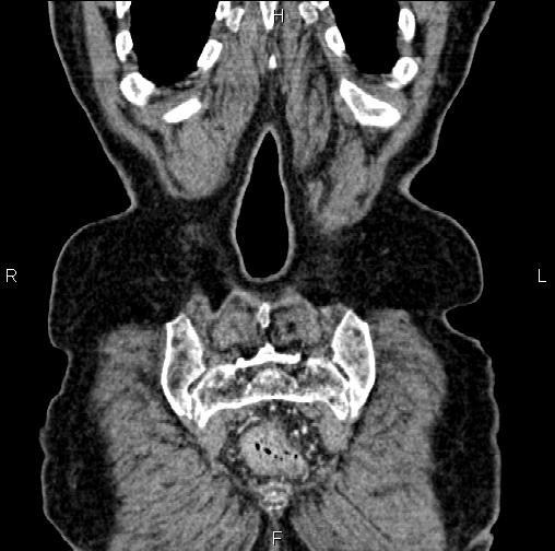 Aortic aneurysm and Lemmel syndrome (Radiopaedia 86499-102554 C 62).jpg