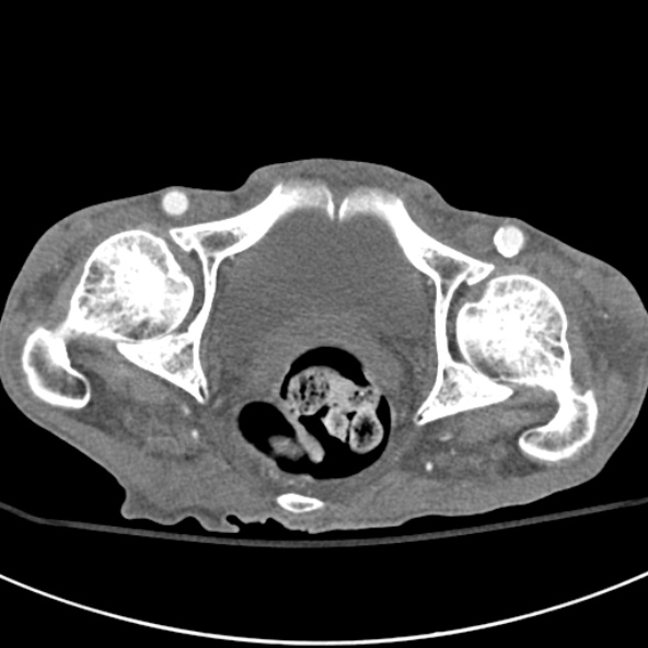 File:Aortic aneurysm with spinal destruction (Radiopaedia 42301-45410 A 108).jpg