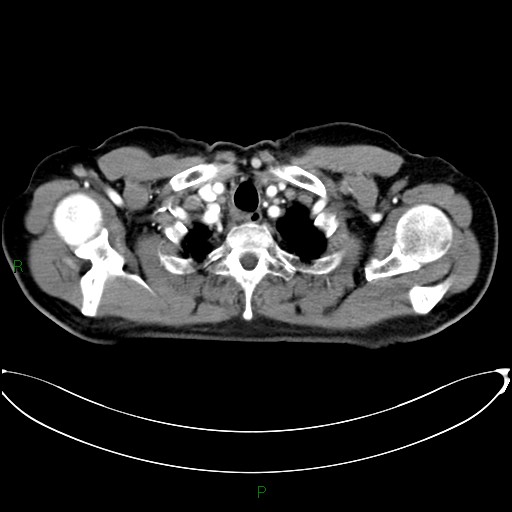 Aortic arch origin of left vertebral artery (Radiopaedia 46327-50737 Axial post contrast 12).jpg