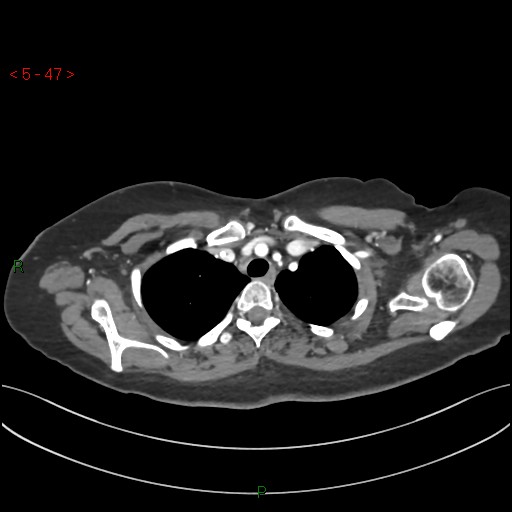 Aortic arch origin of left vertebral artery (Radiopaedia 51520-57286 A 46).jpg