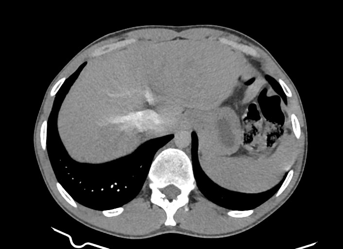 File:Aortic coarctation with aneurysm (Radiopaedia 74818-85828 A 44).jpg
