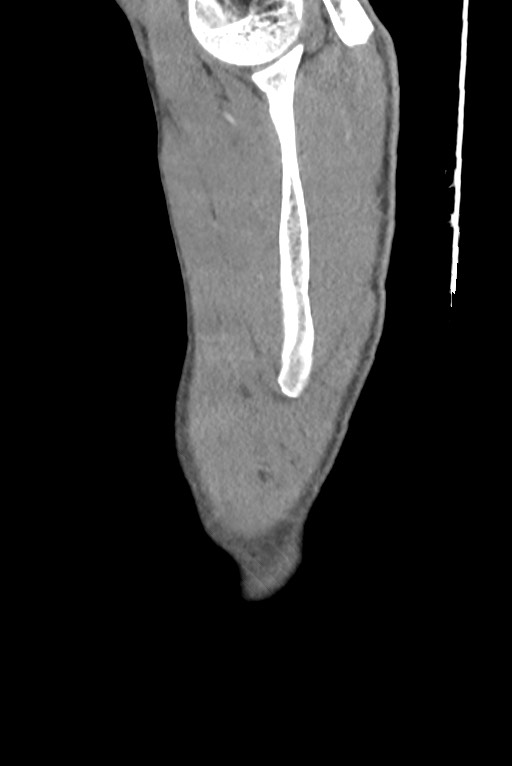 Aortic coarctation with aneurysm (Radiopaedia 74818-85828 B 8).jpg