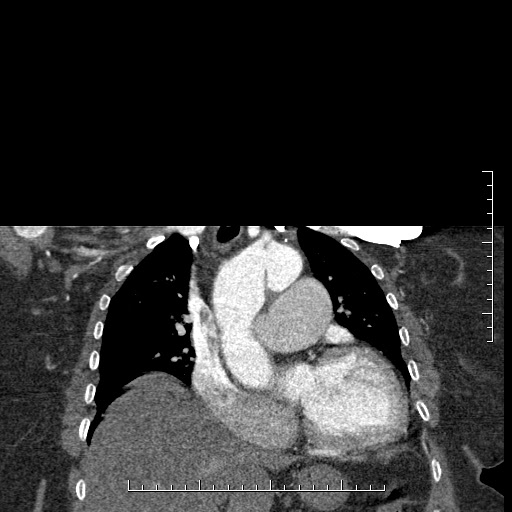 Aortic dissection- Stanford A (Radiopaedia 35729-37268 E 38).jpg