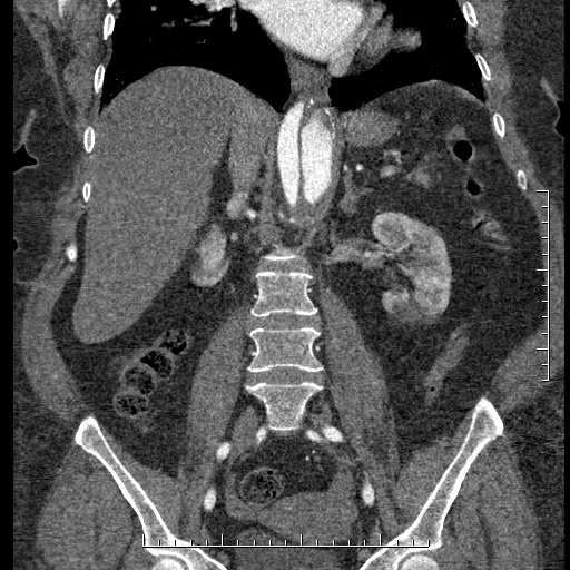 File:Aortic dissection- Stanford A (Radiopaedia 35729-37268 F 24).jpg