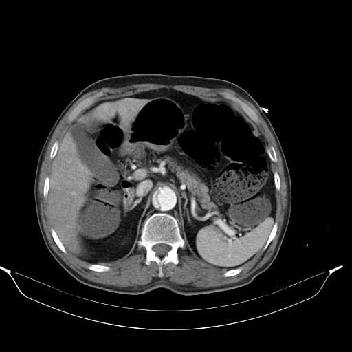 Aortic dissection- Stanford type A (Radiopaedia 22085-22085 A 41).jpg