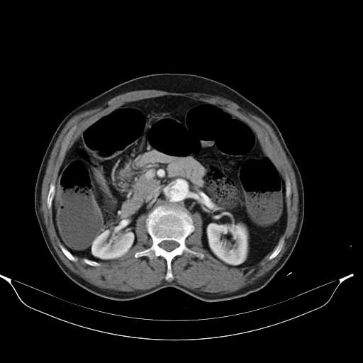 Aortic dissection- Stanford type A (Radiopaedia 22085-22085 A 47).jpg