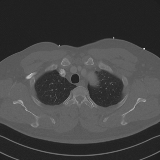 File:Aortic dissection (Radiopaedia 50763-56234 Axial bone window 24).png