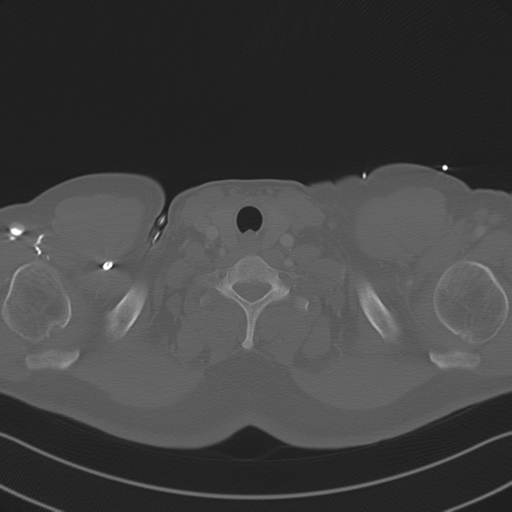 File:Aortic dissection (Radiopaedia 50763-56234 Axial bone window 6).png