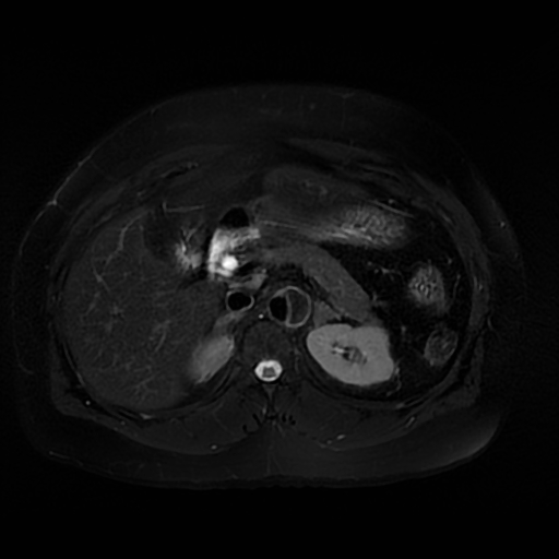 File:Aortic dissection (Radiopaedia 57969-64956 Axial T2 fat sat 25).jpg