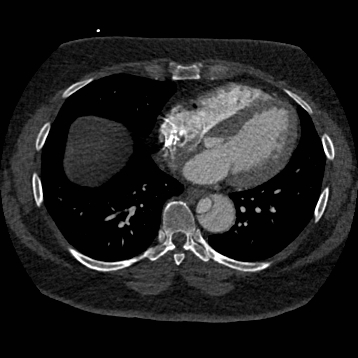 File:Aortic dissection (Radiopaedia 57969-64959 A 201).jpg