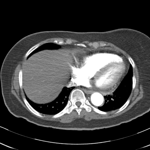 File:Aortic dissection - Stanford type A (Radiopaedia 39073-41259 A 58).png