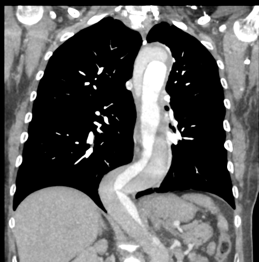 File:Aortic dissection - Stanford type B (Radiopaedia 50171-55512 B 51).png