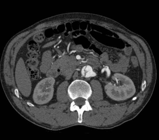 File:Aortic dissection - Stanford type B (Radiopaedia 73648-84437 A 150).jpg