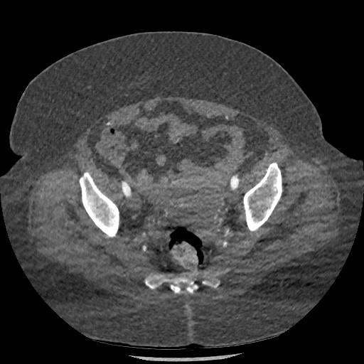 Aortic dissection - Stanford type B (Radiopaedia 88281-104910 A 150).jpg
