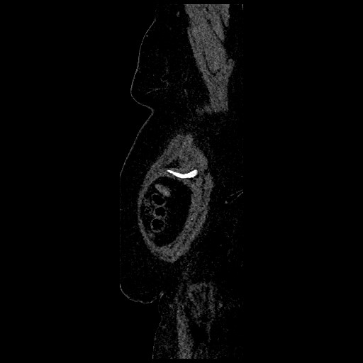 File:Aortic dissection - Stanford type B (Radiopaedia 88281-104910 C 2).jpg