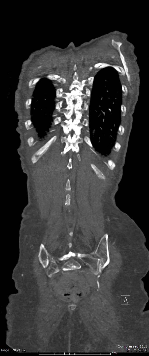 Aortic dissection with extension into aortic arch branches (Radiopaedia 64402-73204 A 70).jpg