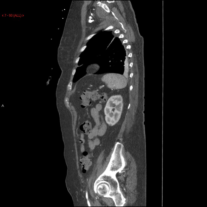 Aortic intramural hematoma (Radiopaedia 27746-28001 C 59).jpg