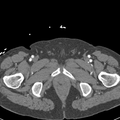 File:Aortic intramural hematoma (Radiopaedia 31139-31838 B 176).jpg