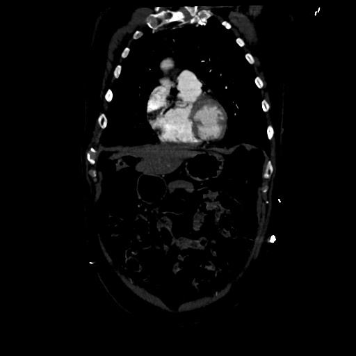 Aortic intramural hematoma (Radiopaedia 34260-35540 C 23).png