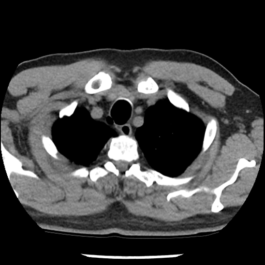 Aortic intramural hematoma (type B) (Radiopaedia 79323-92387 Axial non-contrast 4).jpg