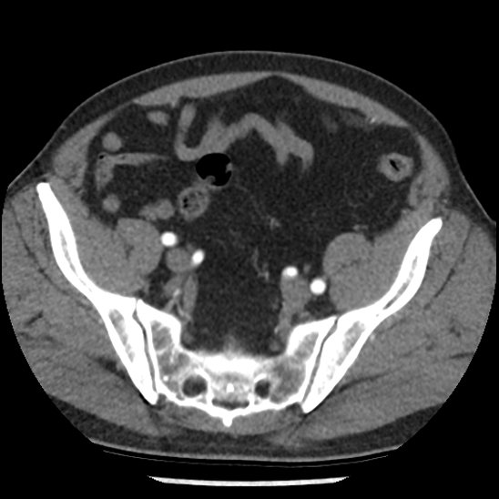 Aortic intramural hematoma (type B) (Radiopaedia 79323-92387 B 97).jpg