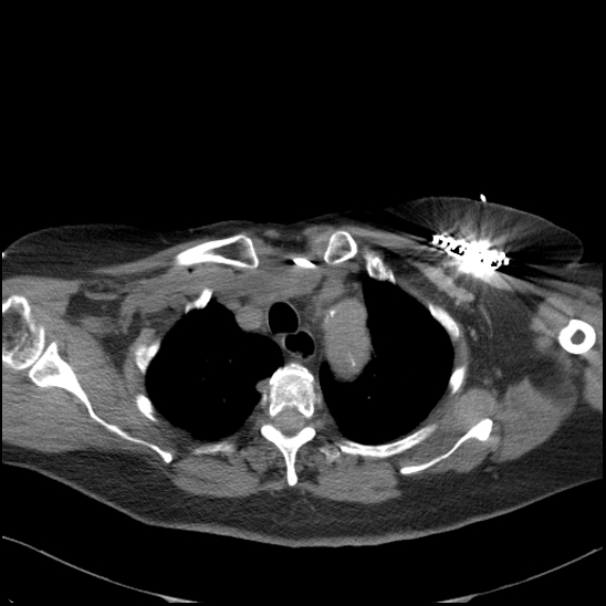 Aortic intramural hematoma with dissection and intramural blood pool (Radiopaedia 77373-89491 Axial non-contrast 22).jpg