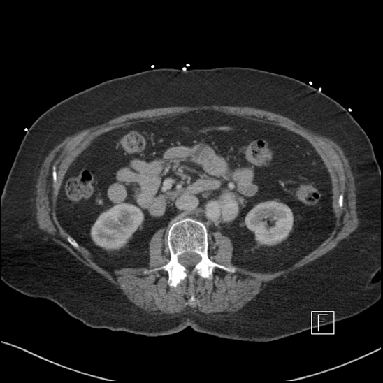 Aortic intramural hematoma with dissection and intramural blood pool (Radiopaedia 77373-89491 E 35).jpg