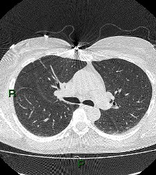File:Aortic valve endocarditis (Radiopaedia 87209-103485 Axial lung window 43).jpg
