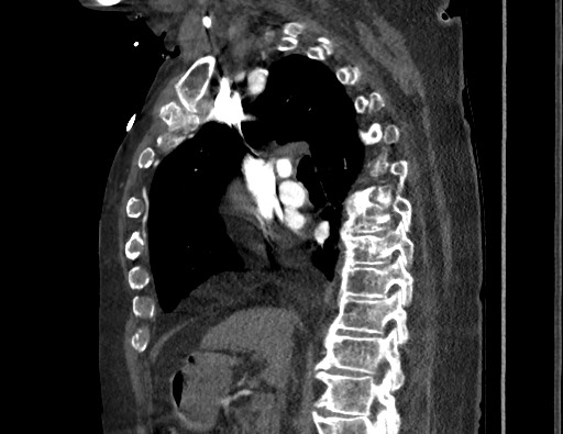 File:Aortoesophageal fistula with endovascular repair (Radiopaedia 73781-84592 Sagittal C+ CTPA 82).jpg
