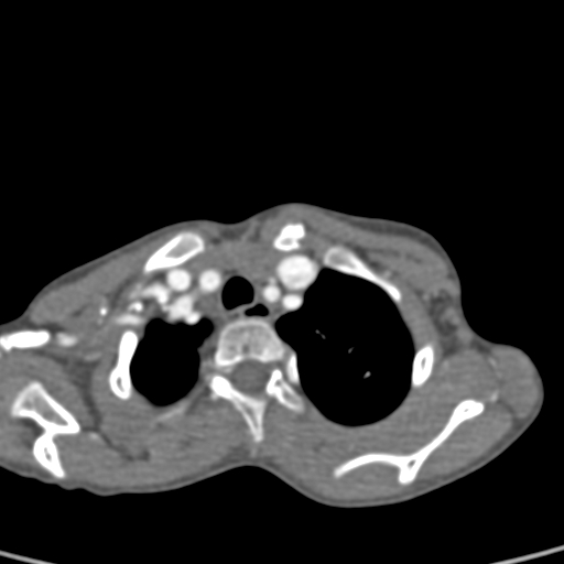 File:Aortopulmonary window, interrupted aortic arch and large PDA giving the descending aorta (Radiopaedia 35573-37074 B 12).jpg