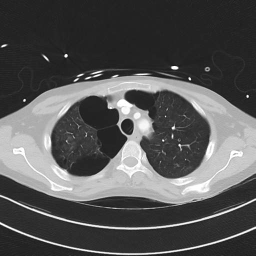 Apical bullous disease in a heavy smoker (Radiopaedia 33067-34092 Axial lung window 16).png
