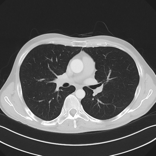 Apical pleural calcification (Radiopaedia 46141-50499 Axial lung window 32).png